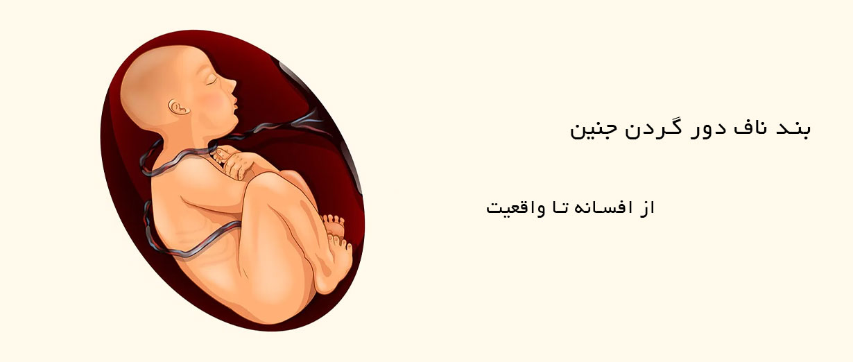 بند ناف دور گردن جنین از افسانه تا واقعیت